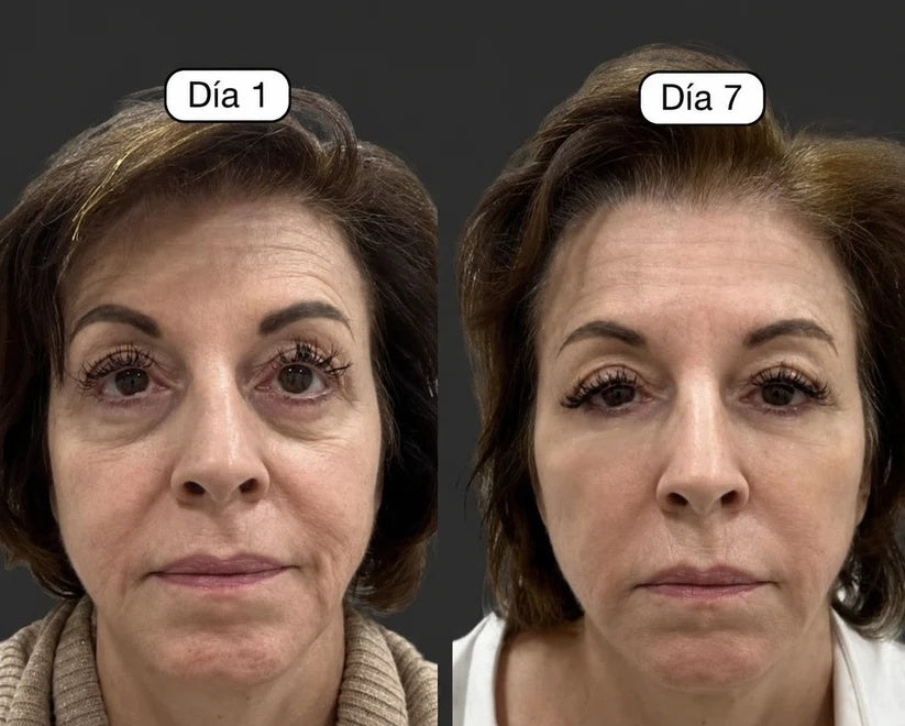 Infografía comparativa de contorno facial